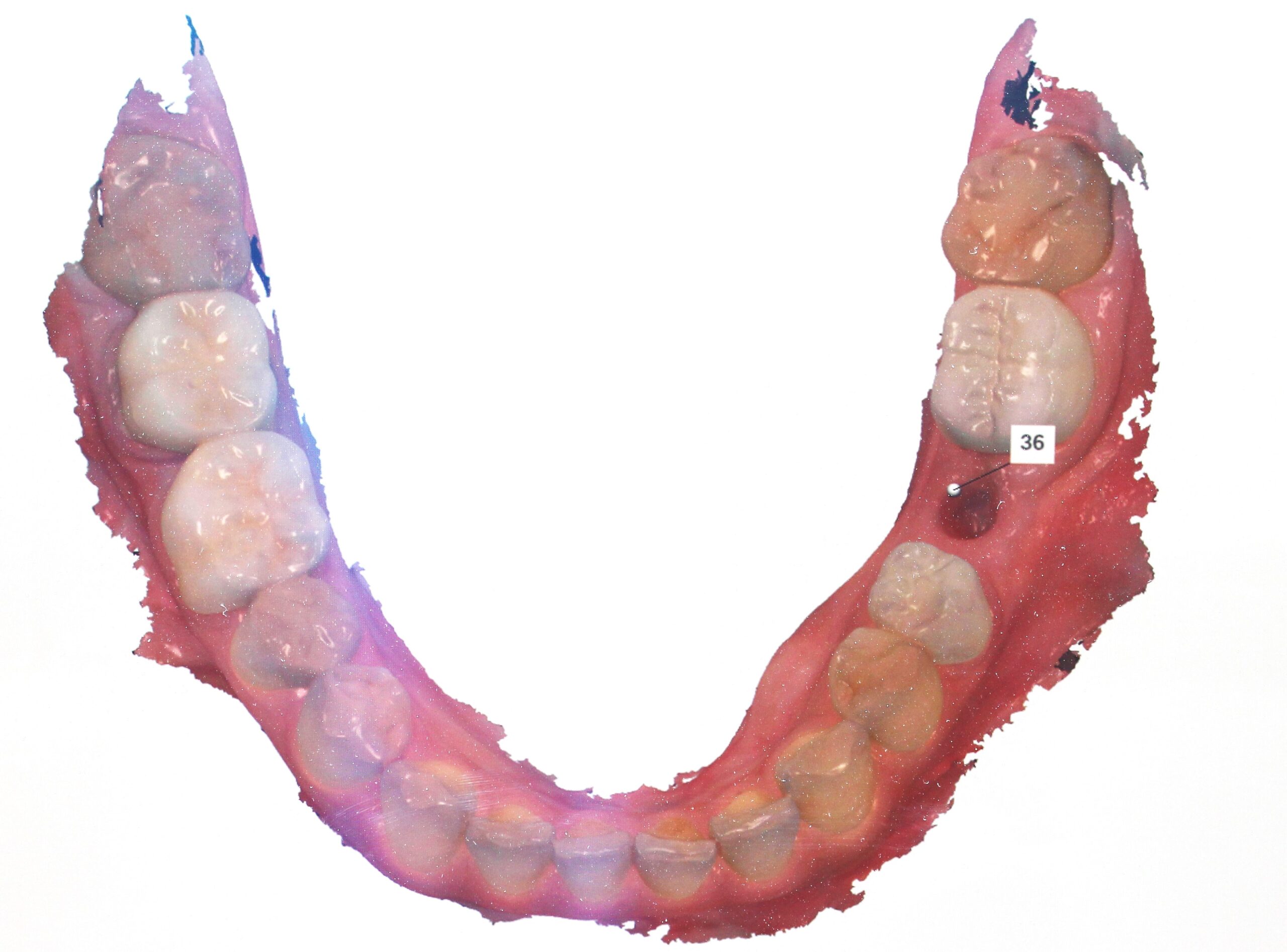 ～親知らず抜歯、智歯抜歯、インプラント～