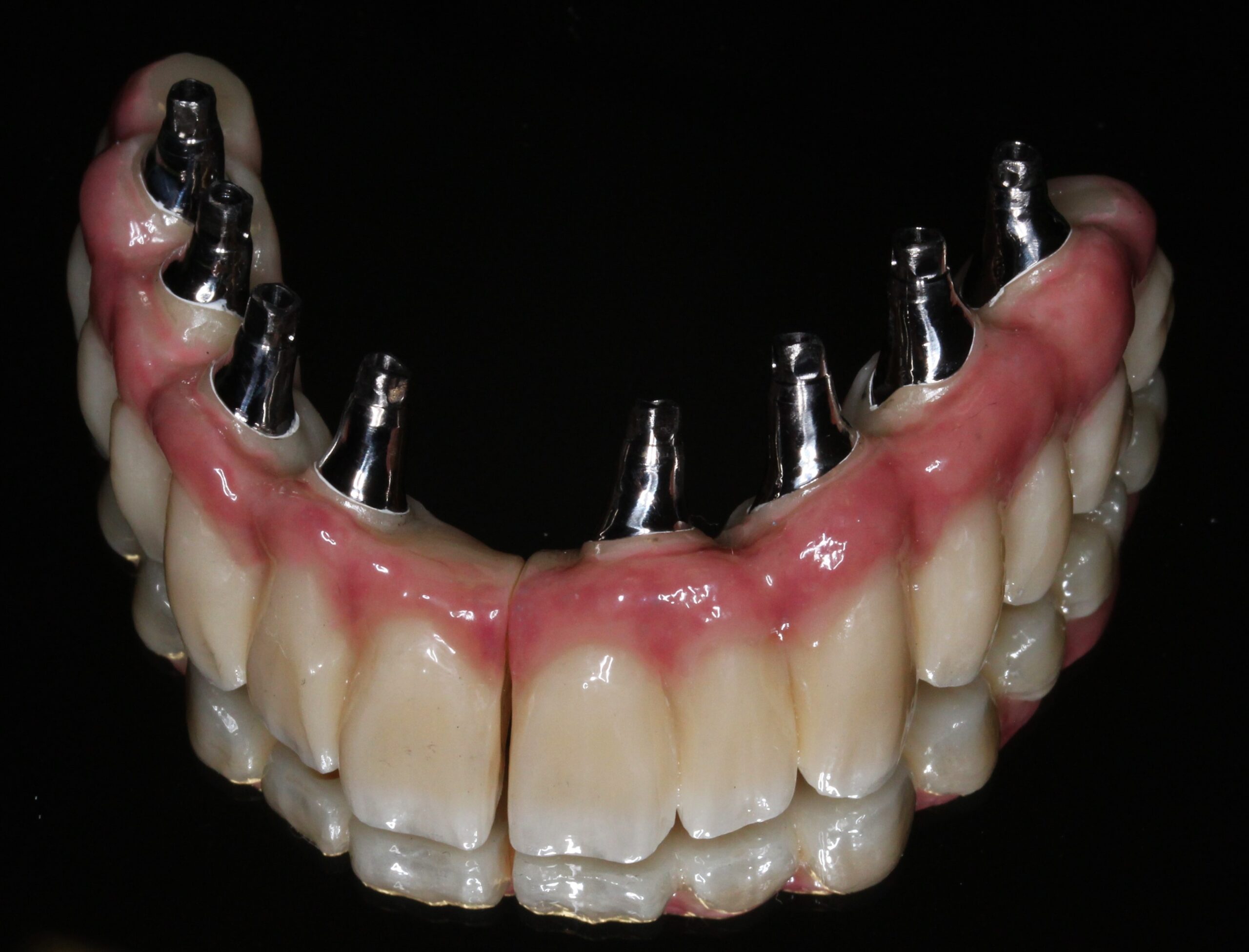 ～親知らず抜歯、智歯抜歯、インプラント～