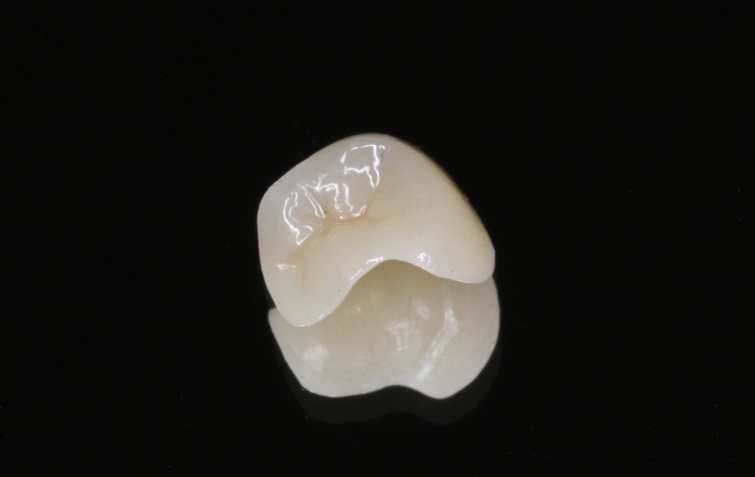 審美歯科　ジルコニアインレー