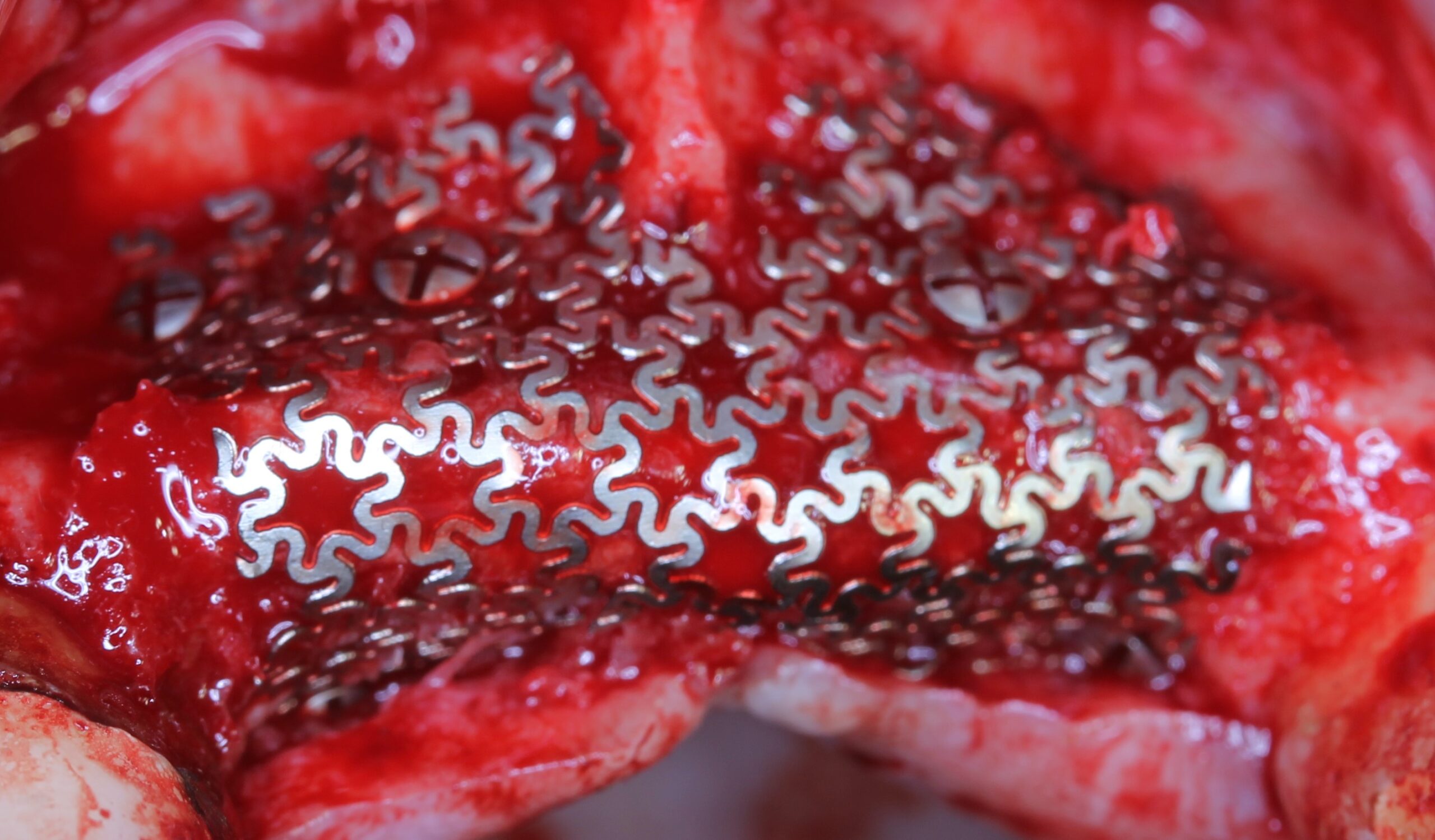 インプラント　骨造成