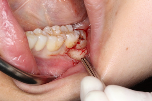 親知らず　智歯　抜歯