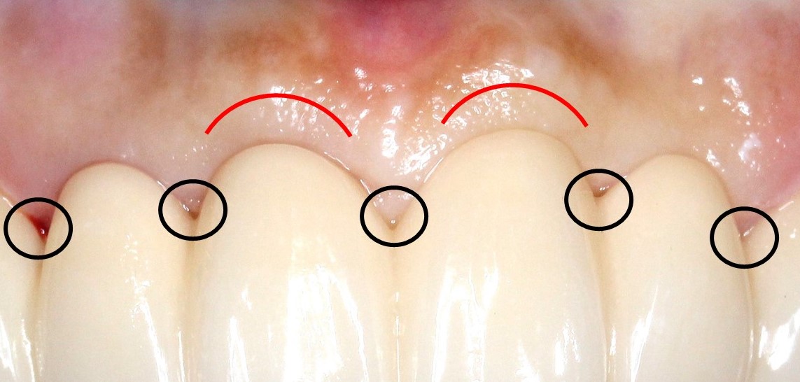 審美歯科　ブリッジ ダミー歯牙部分の歯肉