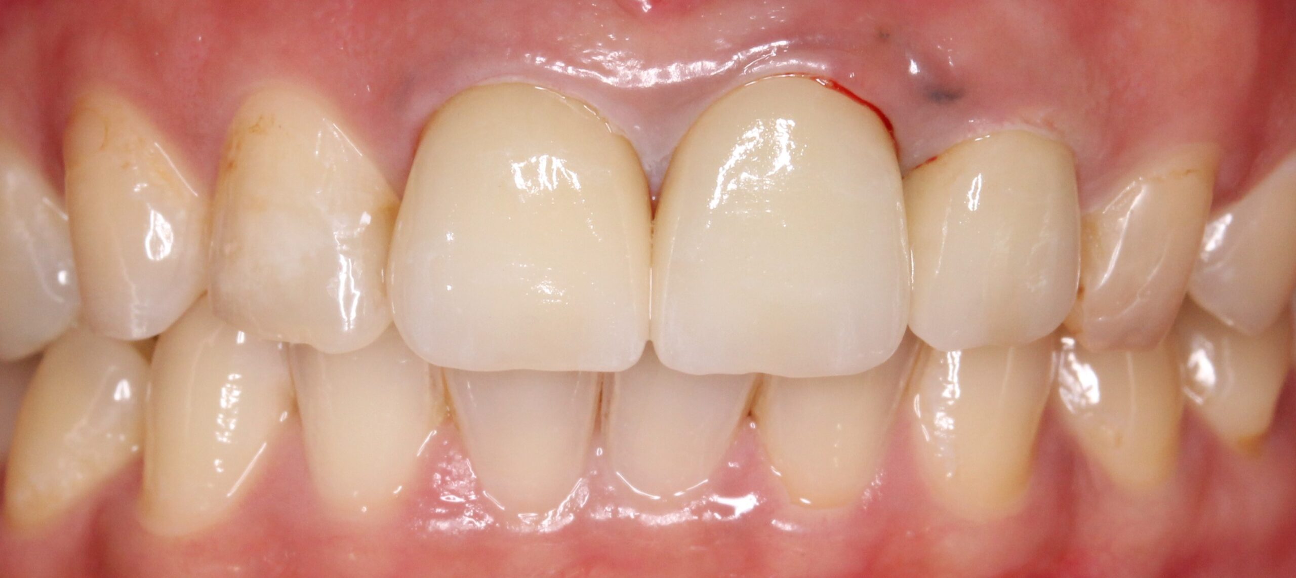 審美歯科　ブラックマージン　メタルタトゥー　フルジルコニアクラウン