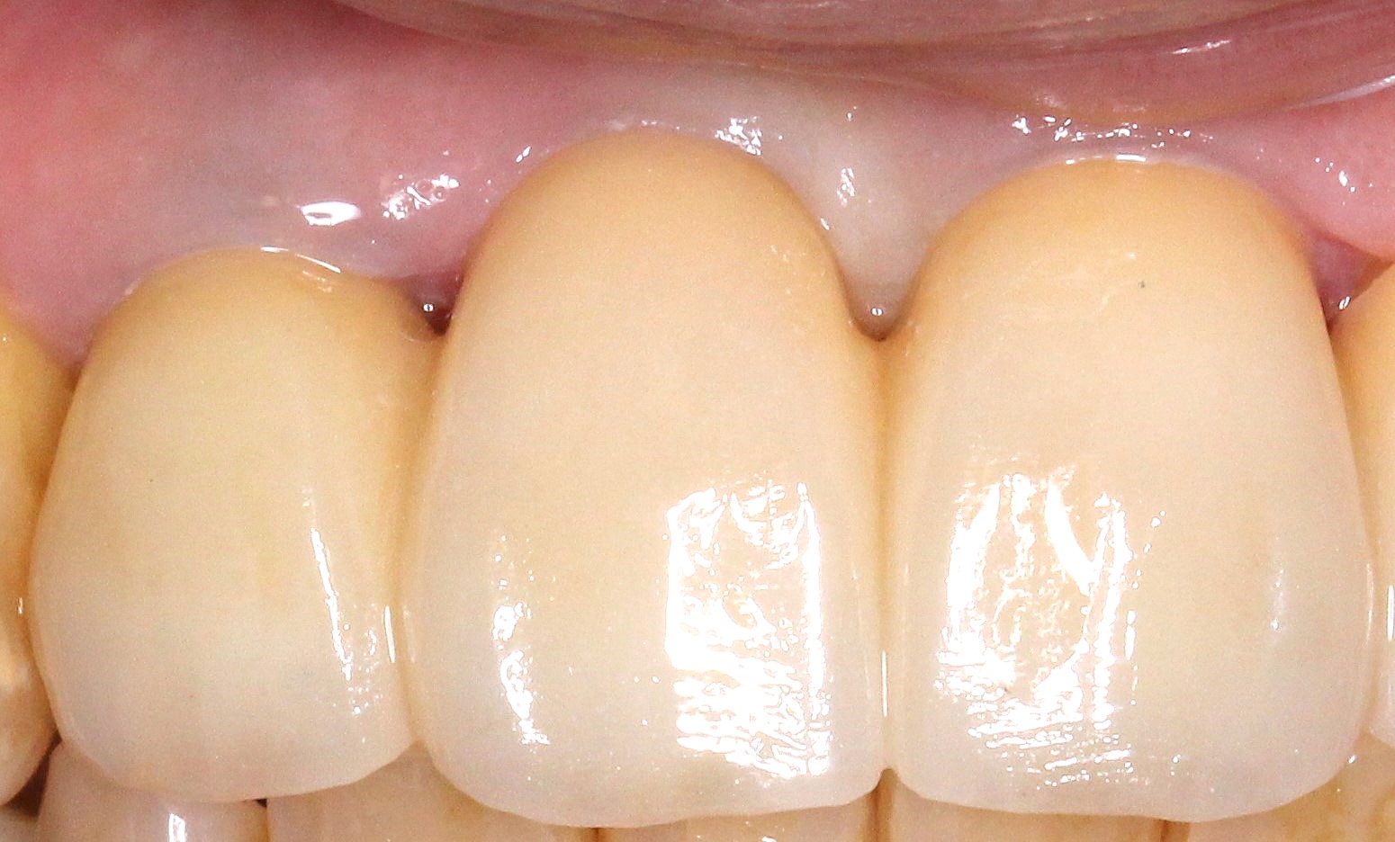 審美歯科　フルジルコニア ポーセレンフェイス