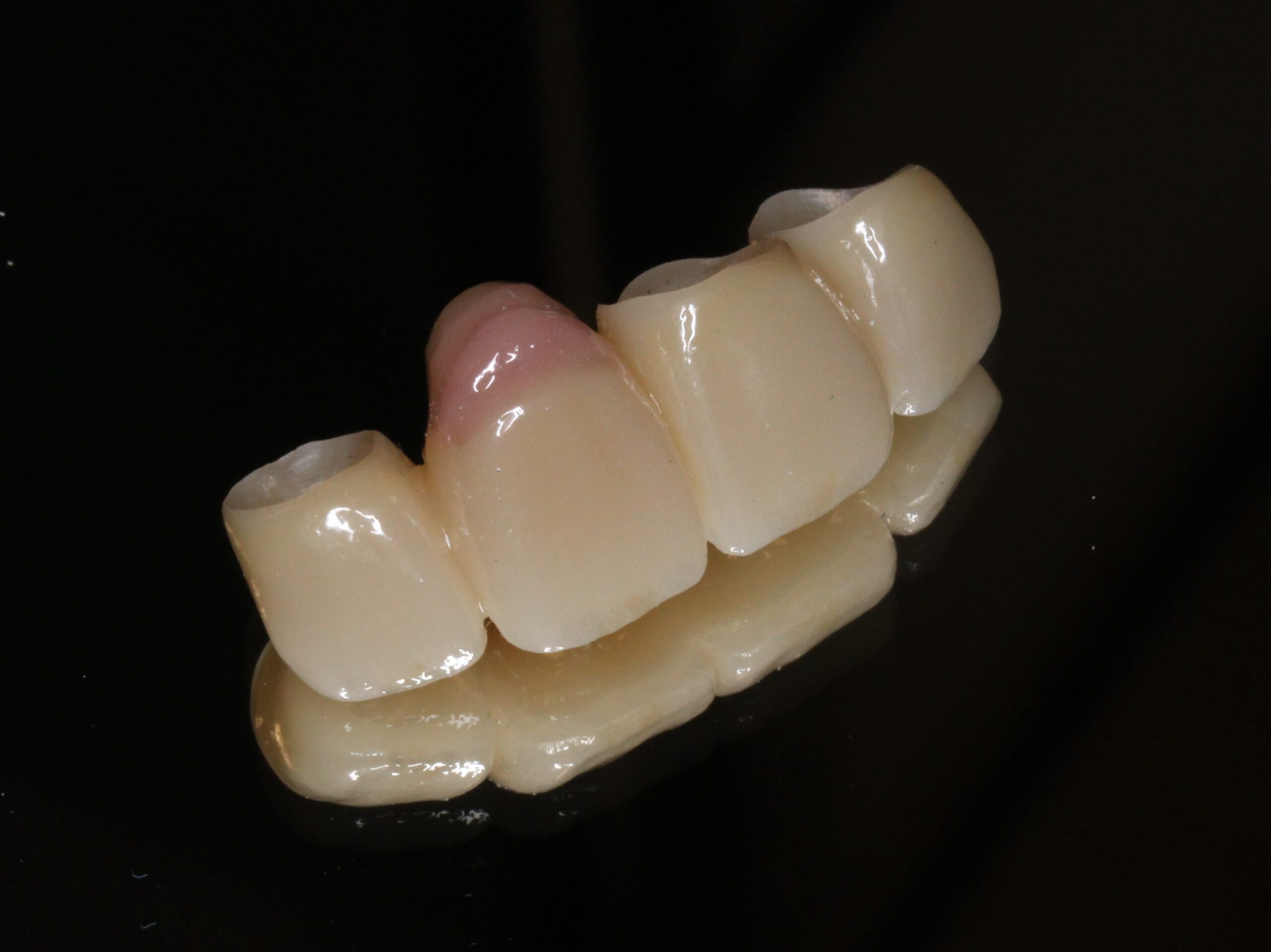 審美歯科　フルジルコニアクラウンブリッジ