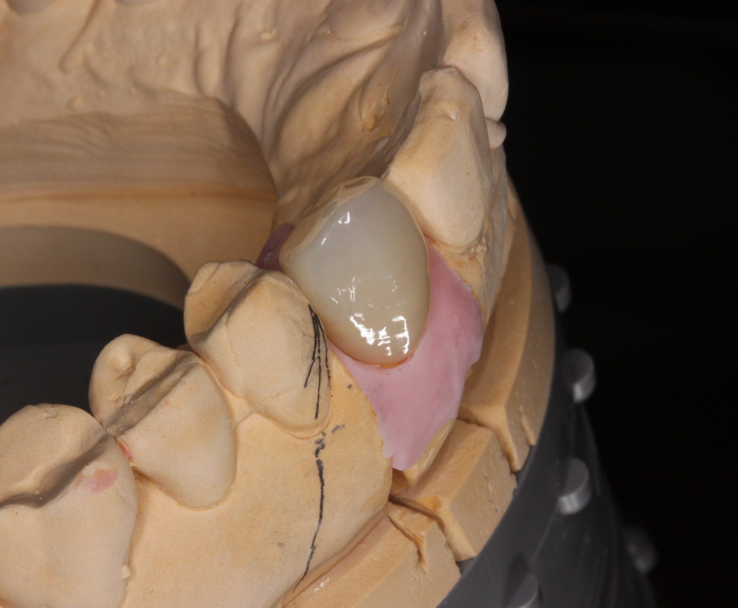 審美歯科　フルジルコニアクラウン