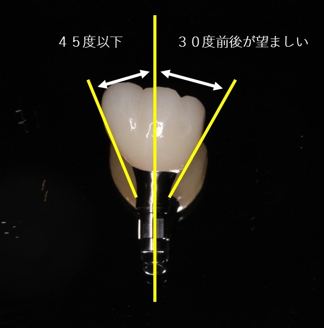 インプラント　エマージェンスプロファイル