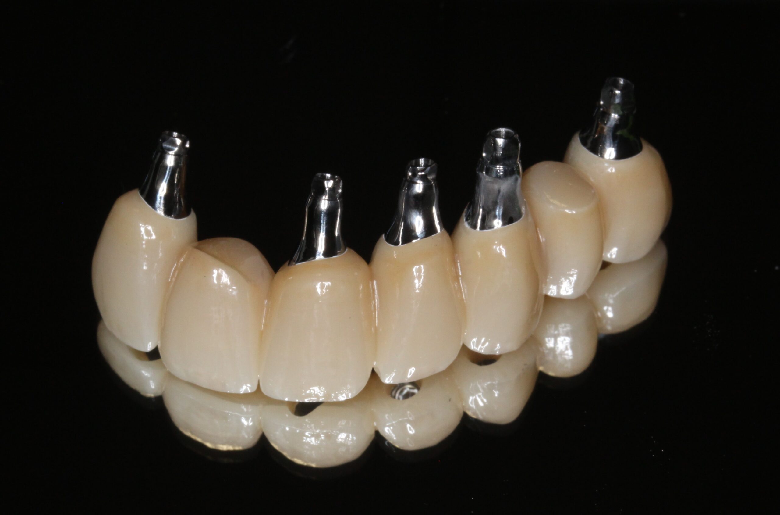 インプラント　前歯　ボーンアンカードブリッジ