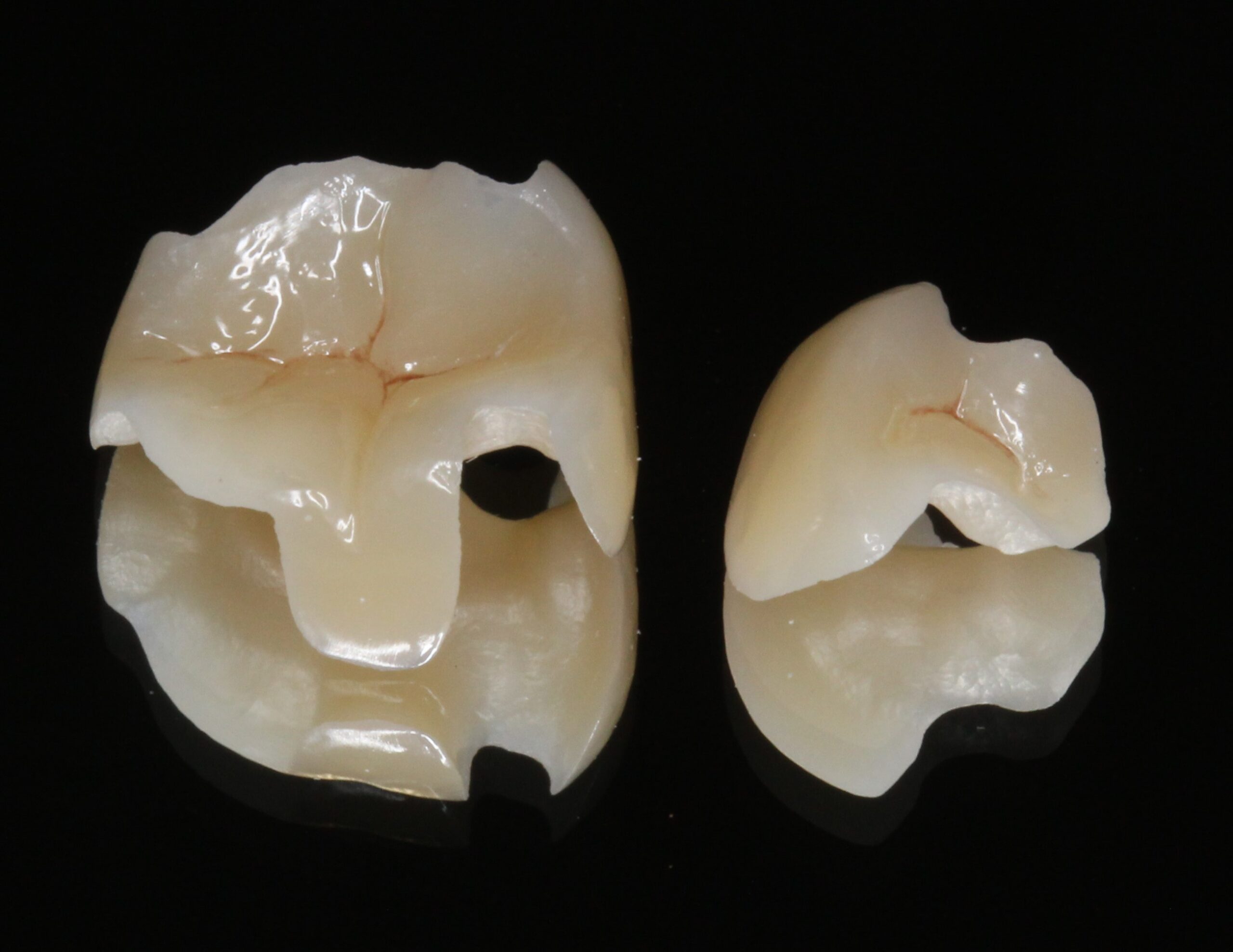 審美歯科　美容歯科　ジルコニアインレー