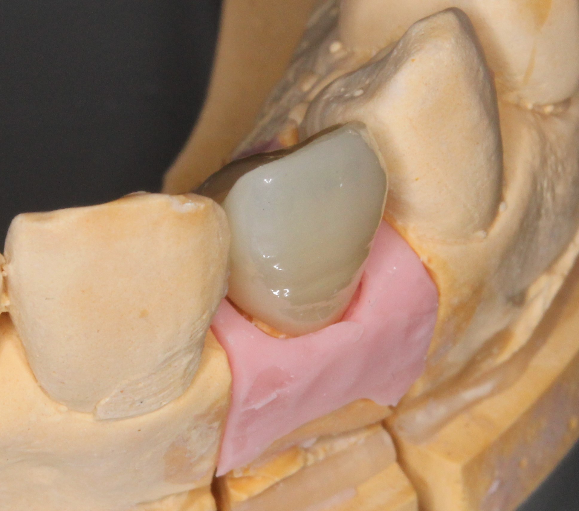 審美歯科　美容歯科　前歯　フルジルコニアクラウン