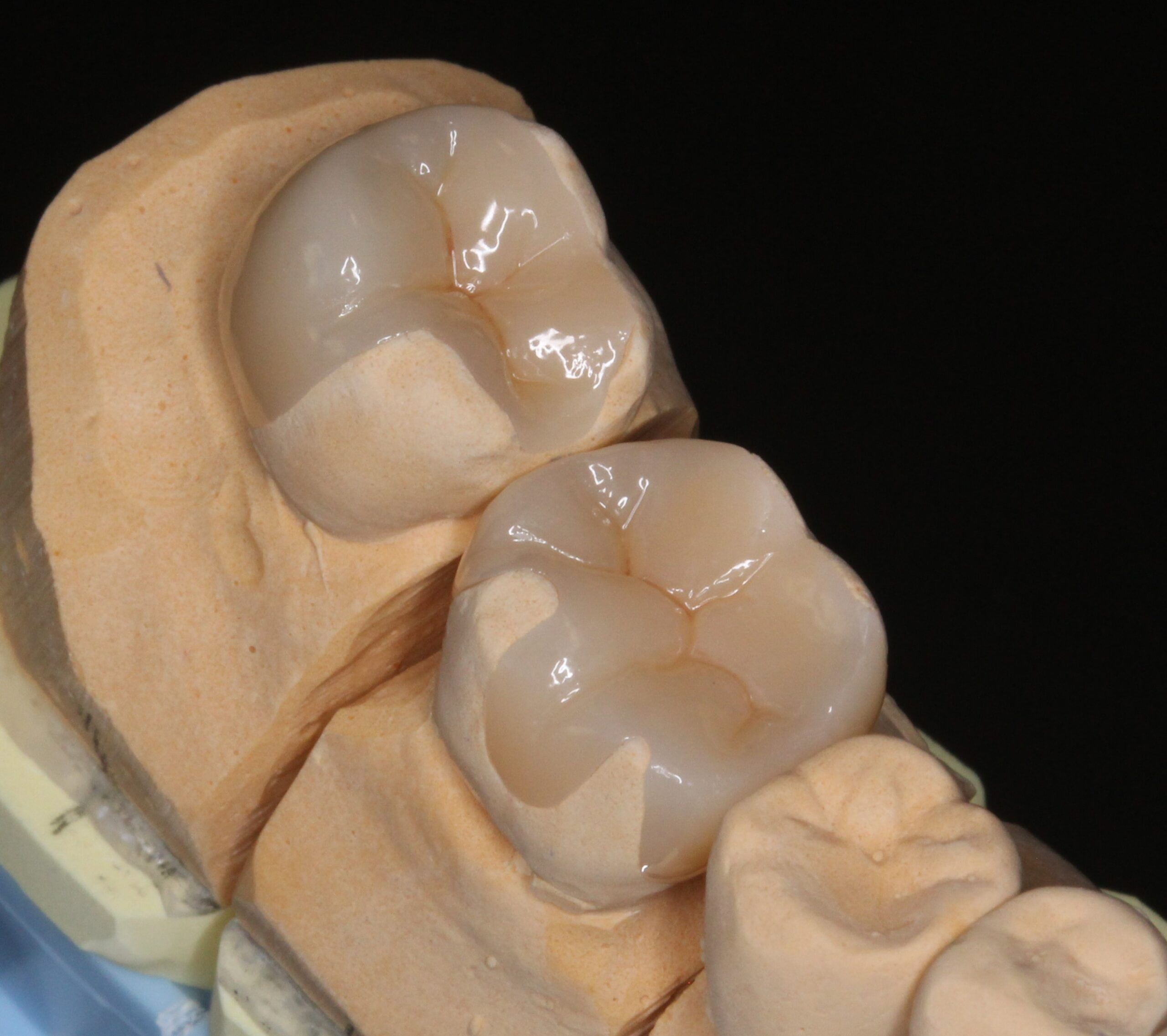 審美歯科 美容歯科 ジルコニアインレー