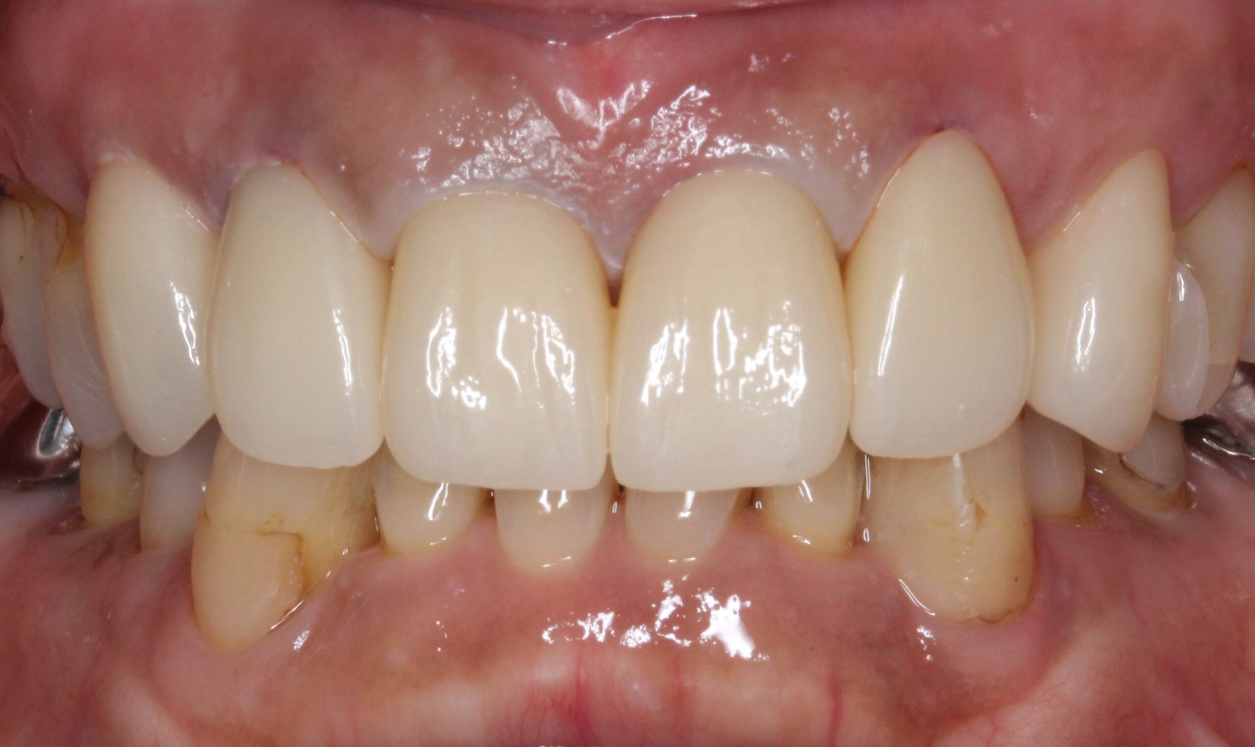 審美歯科　美容歯科　前歯　６歯　フルジルコニアクラウン　メタルタトゥー除去
