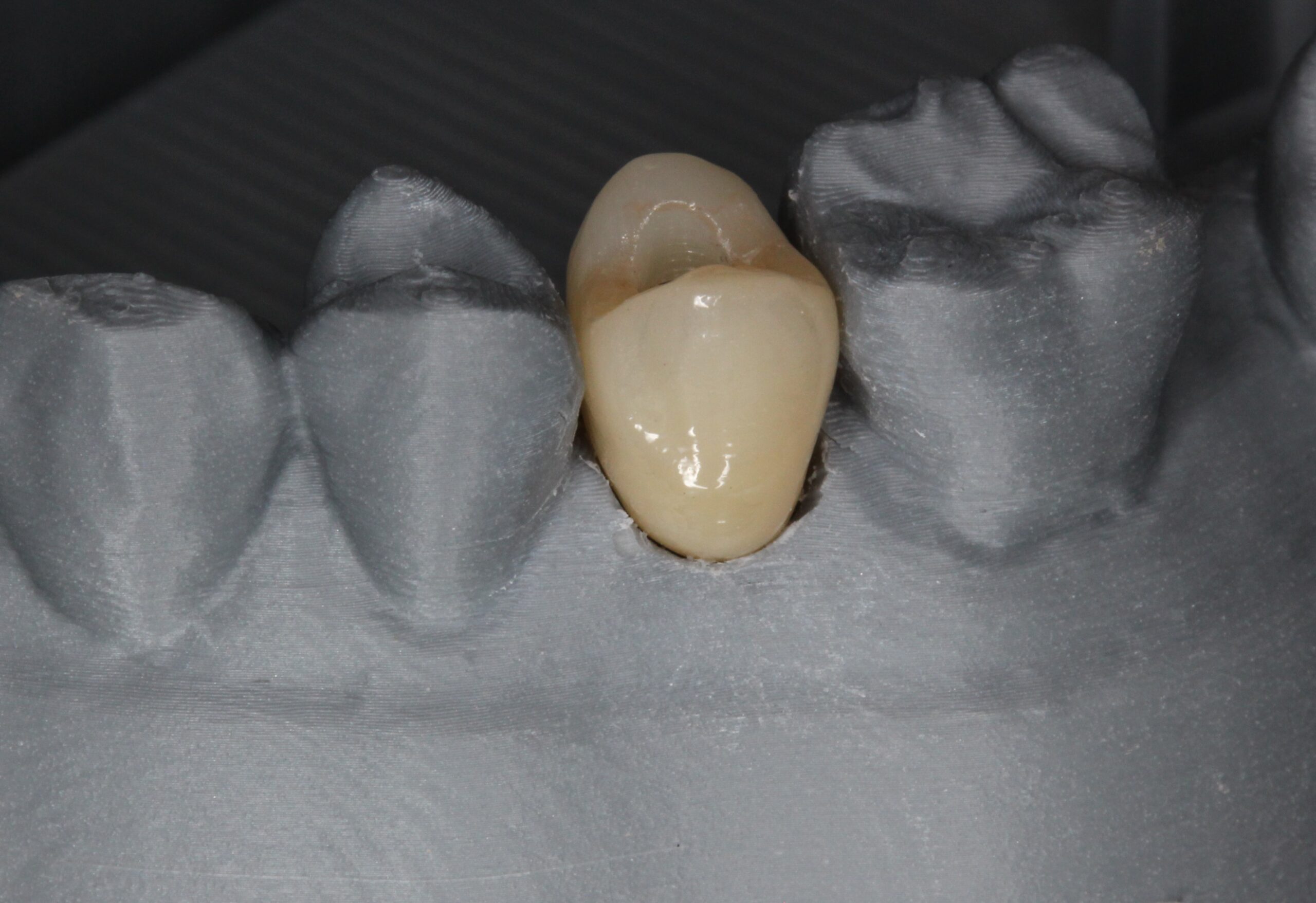 インプラント　スクリュー固定　フルジルコニアクラウン
