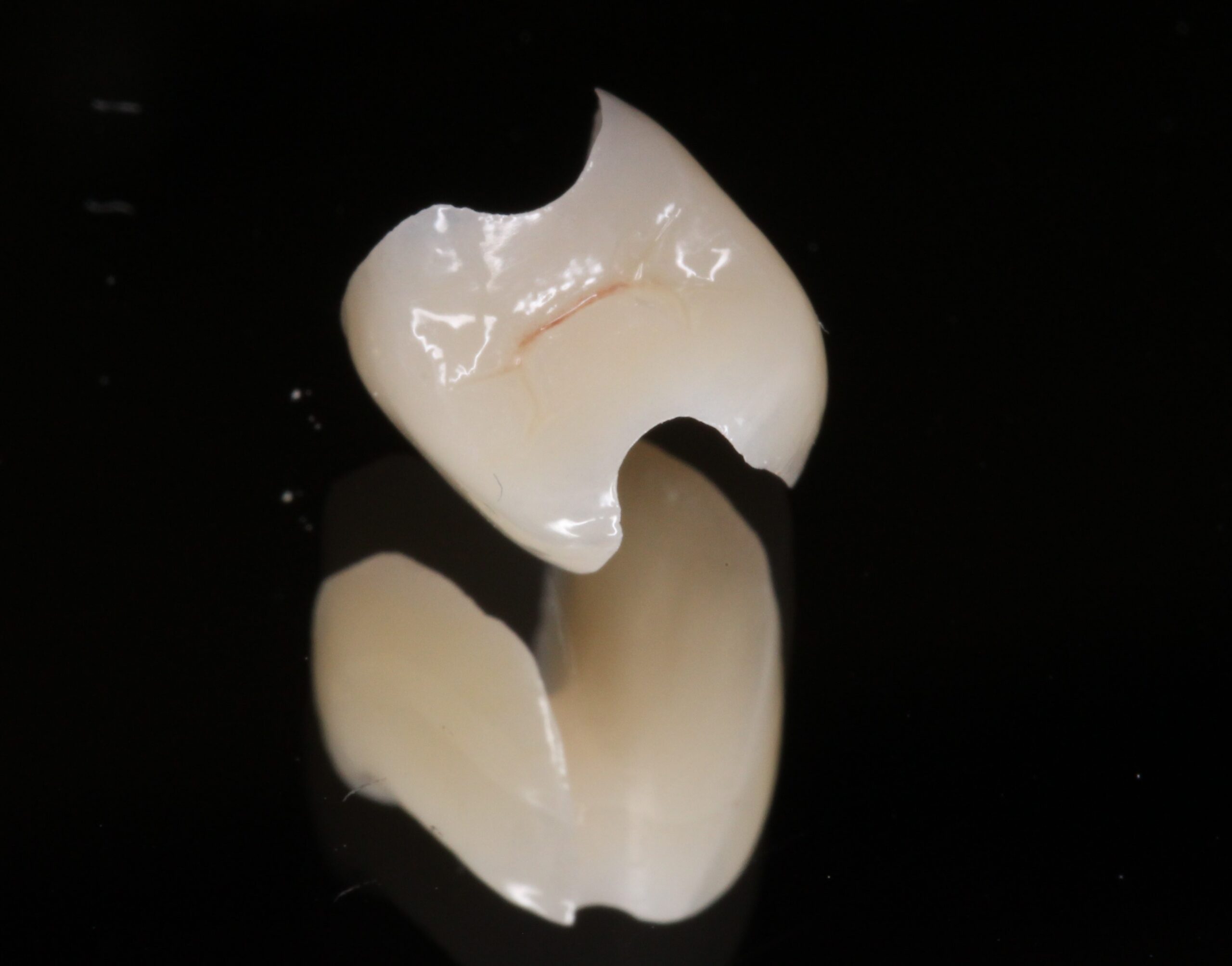 審美歯科　美容歯科　ジルコニアインレー