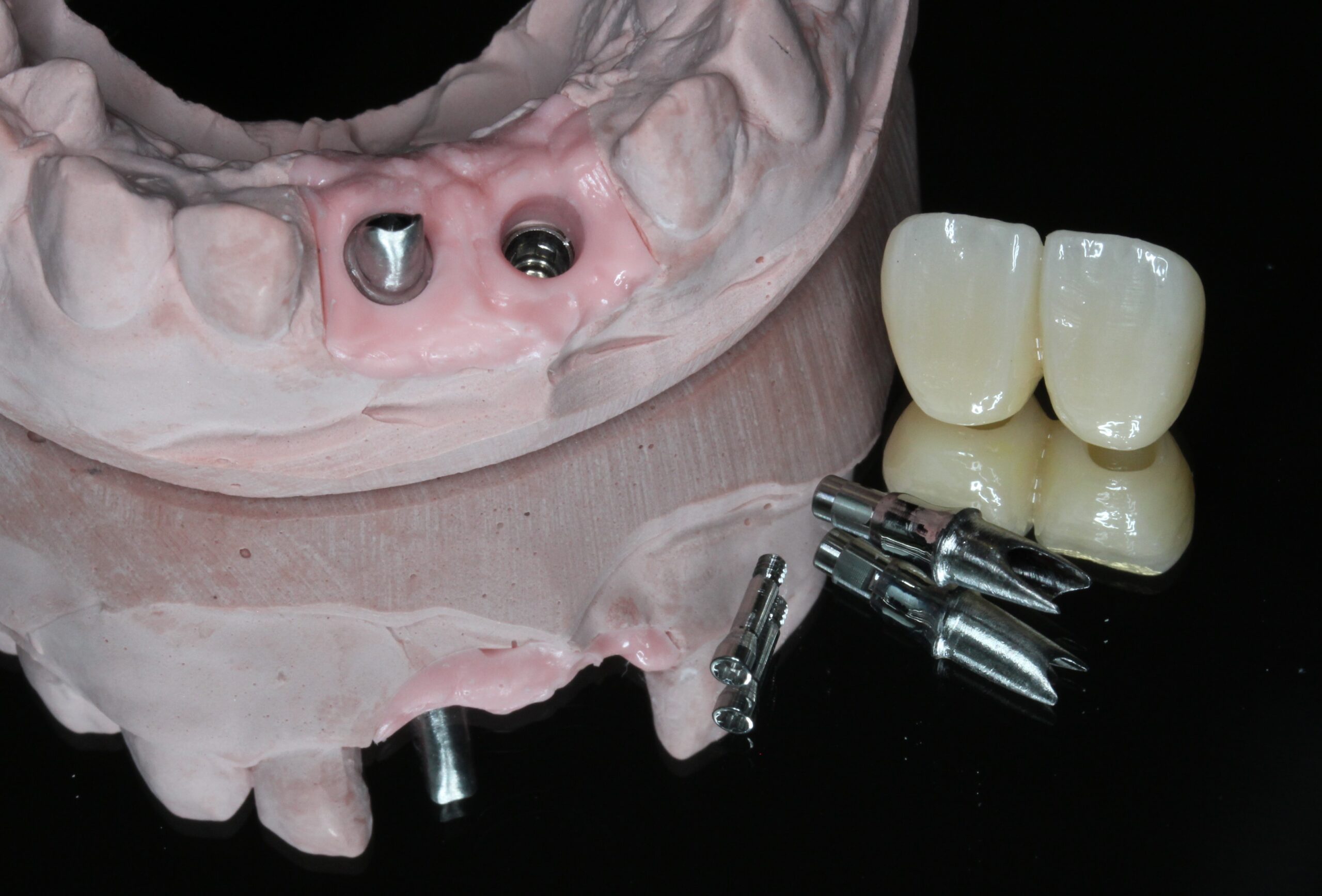 インプラント　前歯　セメント固定
