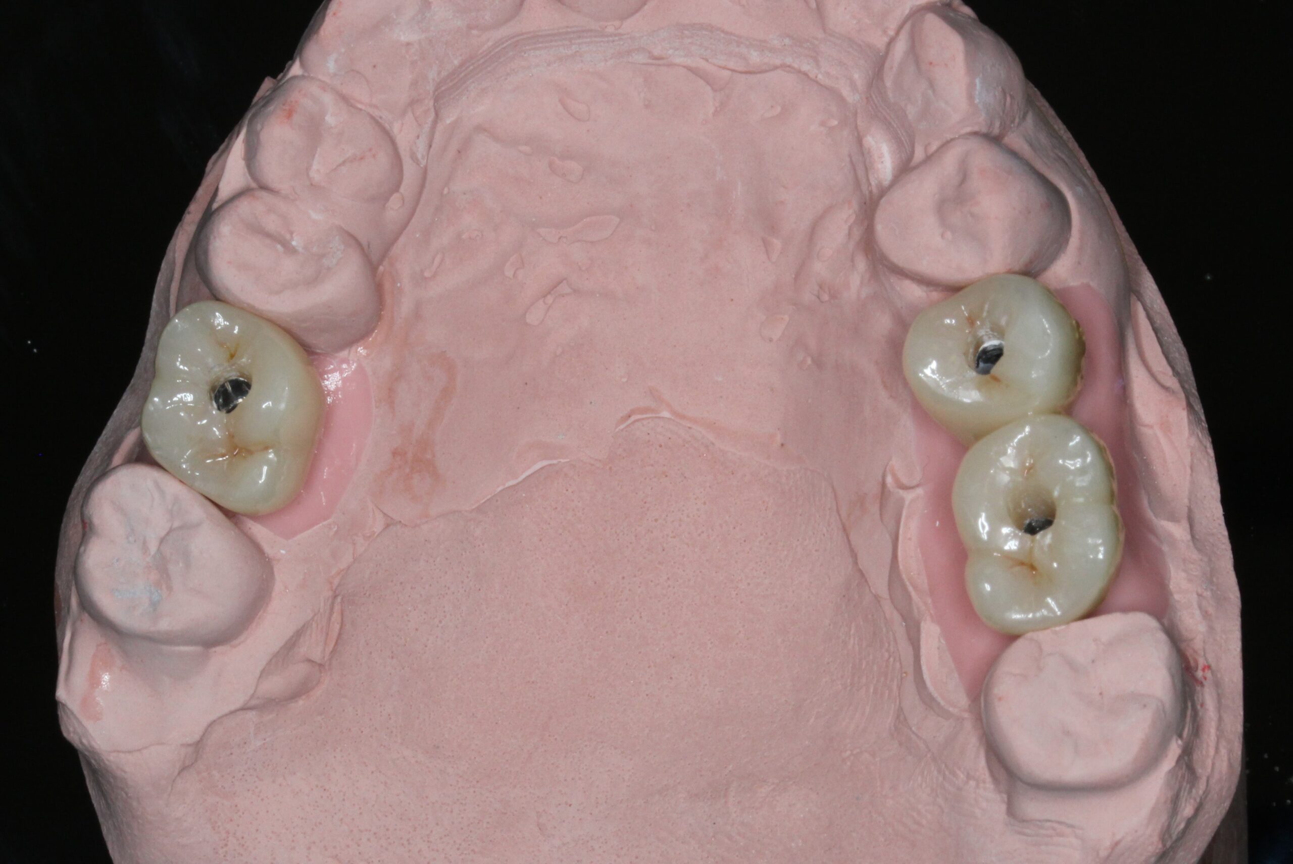 インプラント　臼歯　スクリュー固定