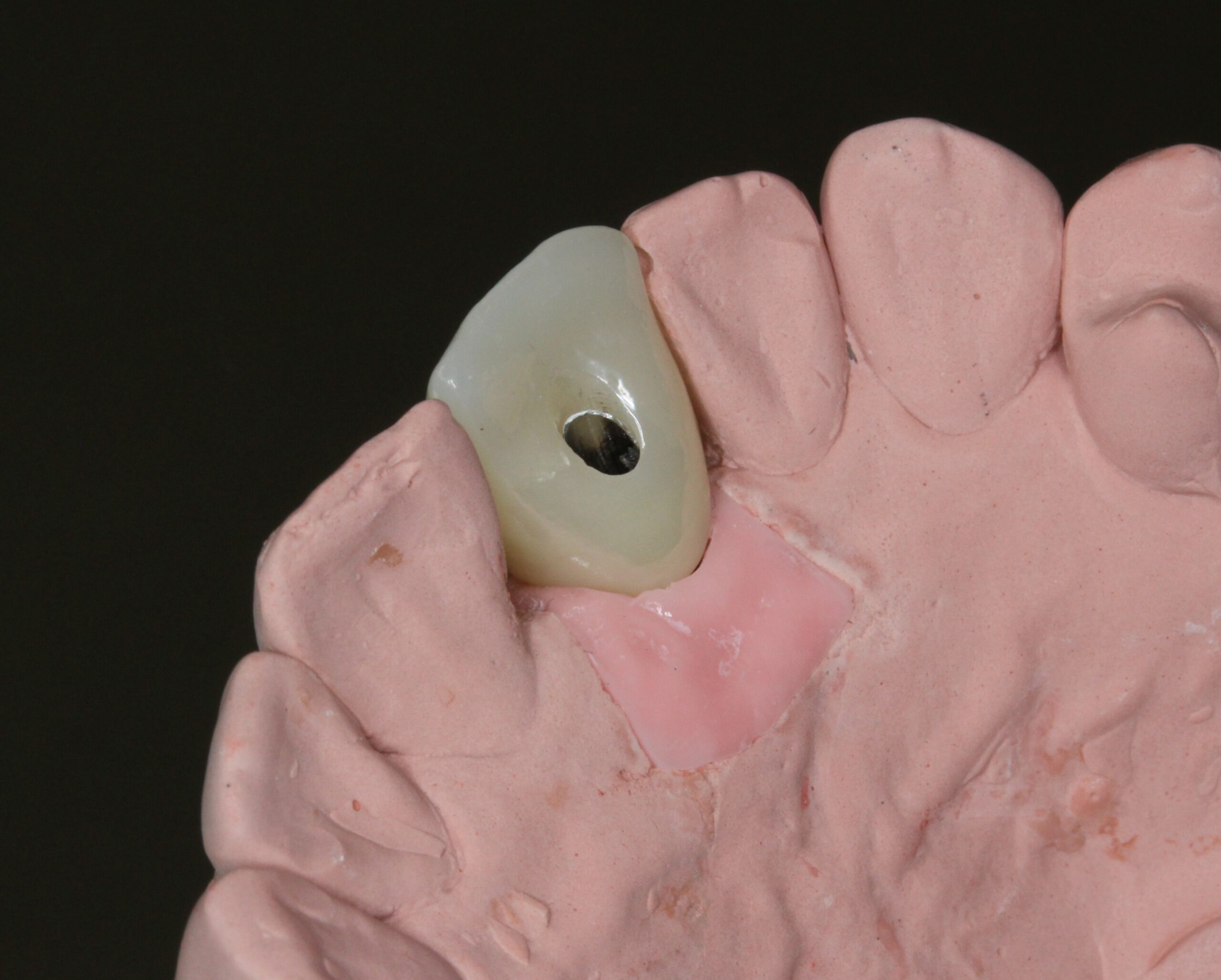 インプラント　前歯　スクリュー固定